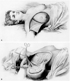 halsted radical mast